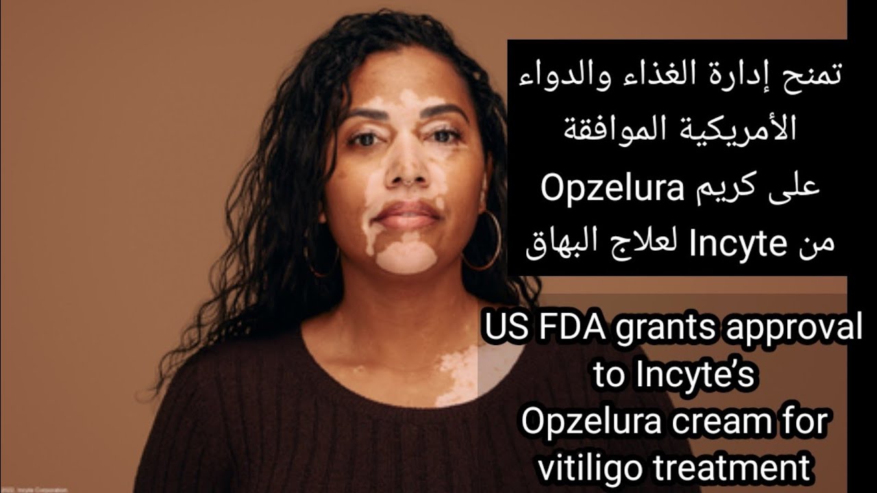تمنحFDAالموافقة على كريمOpzelura لعلاج البهاق FDA grants approval