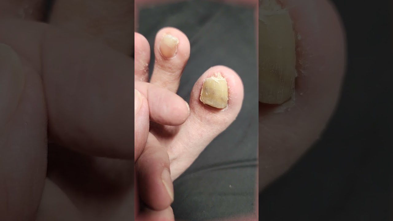 Stubbed My Toe and Didn't Feel It