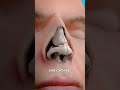 How a nose job works 