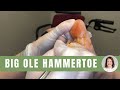 WE ARE BACK!! WITH A BIG OLE HAMMERTOE