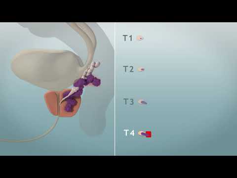 Video: Hoe verskil BPH van prostaatkanker?