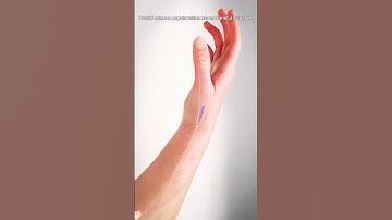 How A Tendon Can Replace Trapezium Bone In Thumb Arthritis? (3D Animation) #3dmedicalanimation #us