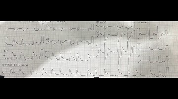 Nhồi máu cơ tim thất Phải