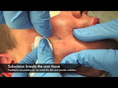 Subscision and surgery for acne scars