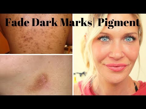FADE PIGMENT: Dark MARKS, Melasma, PIH from ACNE | What ingredients to look for to fade spots!!