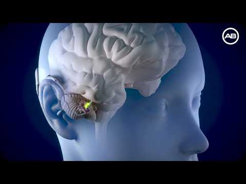 How a Cochlear Implant Works with HiRes Ultra by Advanced Bionics 1080p