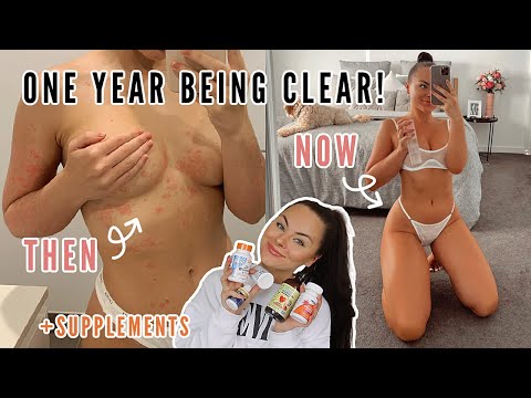 PSORIASIS UPDATE - how I clear flare ups & supplements I take!