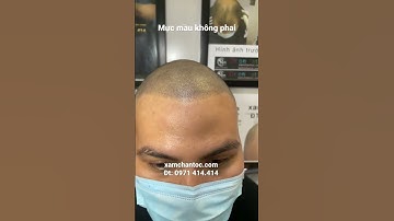 Cận cảnh Xăm tóc hói , hói đỉnh đầu, Xăm chân tóc cho người hói đỉnh đầu