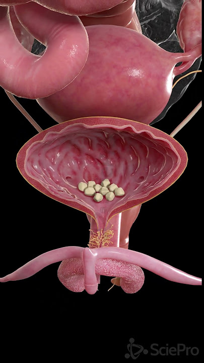 Download lagu Bladder Stones in 3D | Vesical Calculi Anatomy