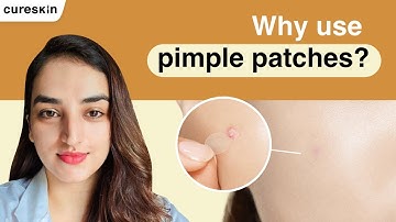 Do pimple patches really work? - Senior dermatologist | Cureskin