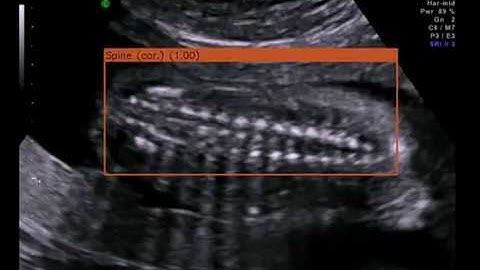 Demonstration of the SonoNet on a real fetal examination