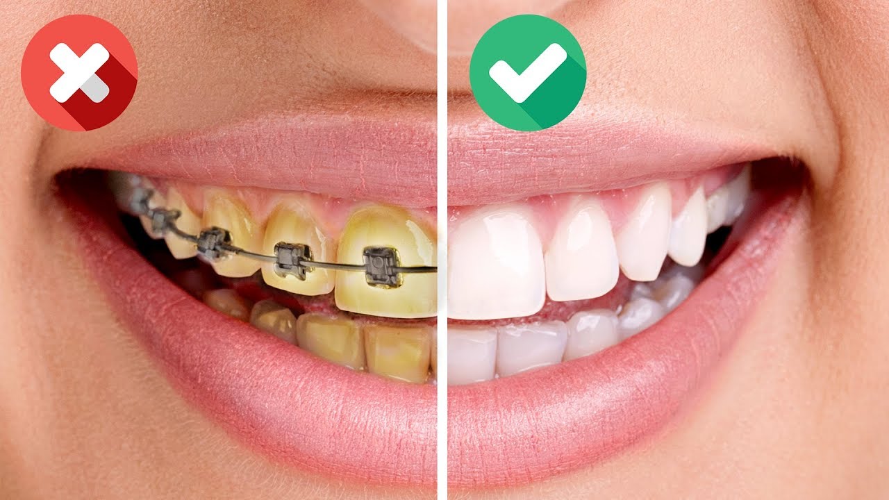 25 BRILLIANT HACKS TO GET HOLLYWOOD SMILE