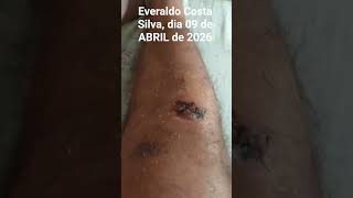 2 PERNAS MACHUCADAS 6 quedas . Hosp. REGIONAL de OSASCO . Osteonecrose BILATERAL na CABEÇA do FÊMUR