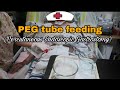 PEG tube feeding