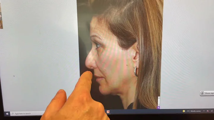 Reconstruction Revision Rhinoplasty by Dr. Philip Solomon in Toronto