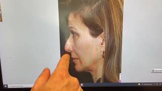 Reconstruction Revision Rhinoplasty by Dr. Philip Solomon in Toronto