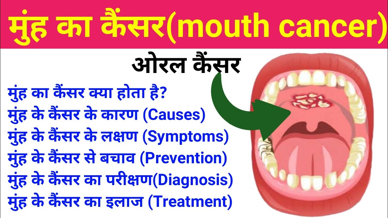 मुंह का कैंसर oral cancer mouth cancer symptoms, treatment