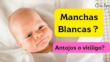 ¿Por qué los bebés nacen con una mancha blanca?