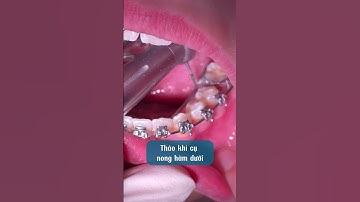 Khí cụ nong hàm dưới #shorts #braces