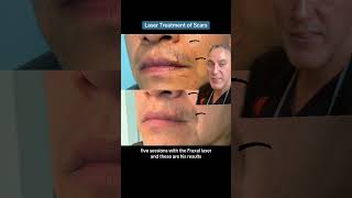 Laser Treatment of Scars