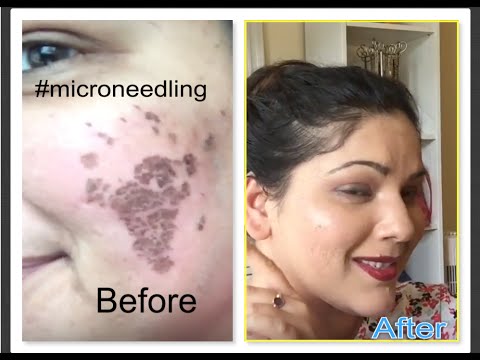 My new face| Microneedling| Acne scar treatment Day 