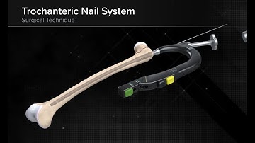 Trochanteric Nail System