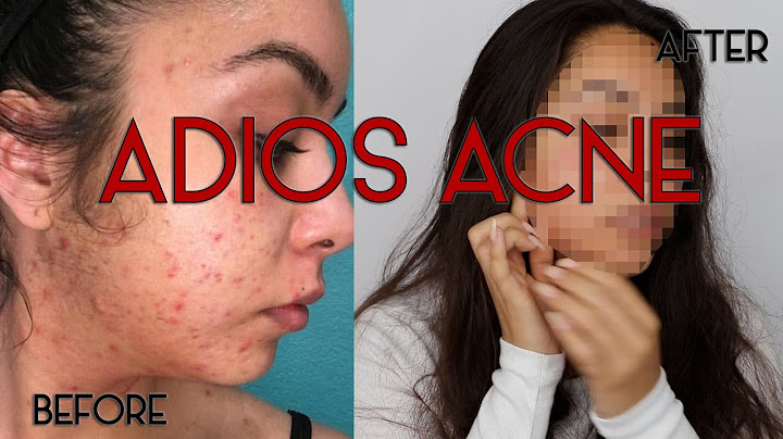 Como me deshice de mi acne - How I got rid of my acne