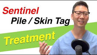 Can I remove Sentinel Piles or Sentinel Skin Tags? | Dr. Chung tells you the options!