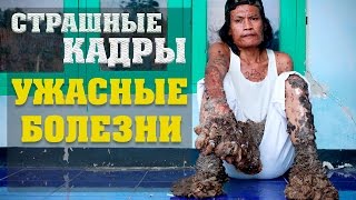 5 УЖАСНЫХ ЗАБОЛЕВАНИЙ ( Страшные кадры )