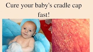Follow these steps to remove cradle cap naturally and cure it for good! #cradlecap #momhacks Creator on the Rise: My first 500 
