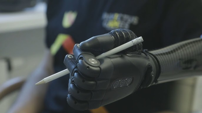 Ukraine War Veteran Gets Bionic Prosthetic Arm