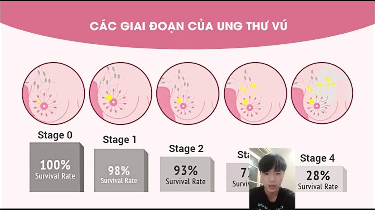 Рак молочной железы 1 стадии фото Breast Cancer Clinical Gate