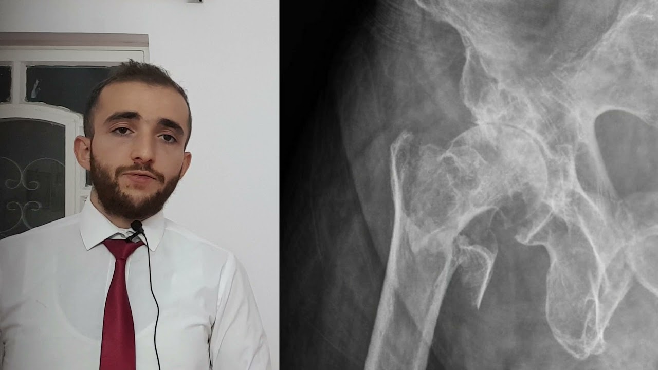 LL: intertrochanteric fracture l  كسر بين المدور الفخذي