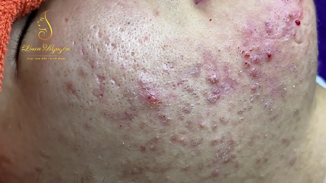 Blackheads Removal (333a) | Loan Nguyen