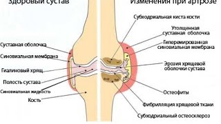 Артриты и Артрозы. Как Помочь Организму.#Артриты и Артрозы. Артриты и Артрозы. Как Помочь Организму.#Артриты и Артрозы.