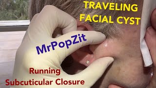 See The Facial Cyst That Blooms Like A Flower.see The Hidden Running Subcuticular Suture.