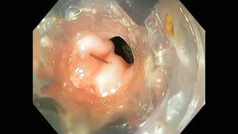 PADLOCK CLIP™ System – Endoscopic clip used for colon perforation closure in a porcine model