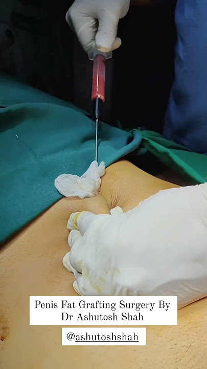 Penis fat grafting surgery  | Dr. Ashutosh Shah | Elegance Clinic - Surat