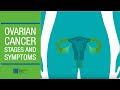 Understanding Ovarian Cancer Stages and Symptoms