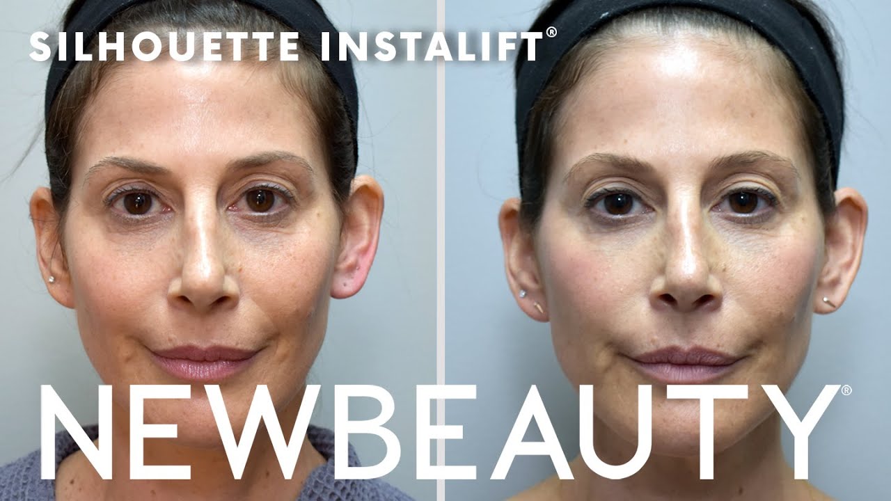 Instalift® A Nonsurgical Procedure That Instantly Lifts The Mid Face