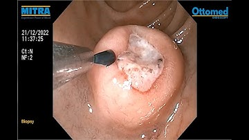 Upper Gastrointestinal (UGI) Endoscopy & Biopsy Procedure using Ottomed Endoscopy SmartEye - II Plus