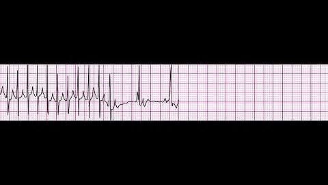 SVT Converting to NSR after Adenosine