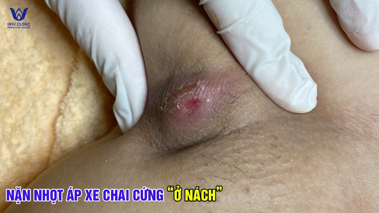 Nặn mụn nhọt áp xe ở nách - Tại phòng khám da liễu HHV Clinic.