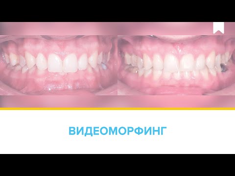 Результаты лечение глубокого прикуса без удаления на самолигирующих металлических брекетах Damon Q