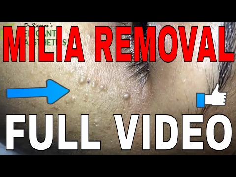 MILIA REMOVAL