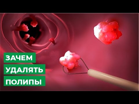 Зачем удалять полипы и новообразования толстого кишечника