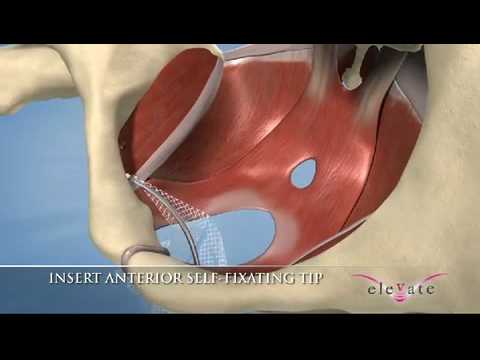 elevate - Anterior & Apical Prolaps Repair System - سرجیکل اور متحرک طریقہ کار ویڈیو۔