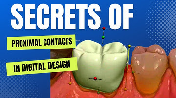 Secrets to Proximal Contacts in Digital Design - 3Shape Crown Design