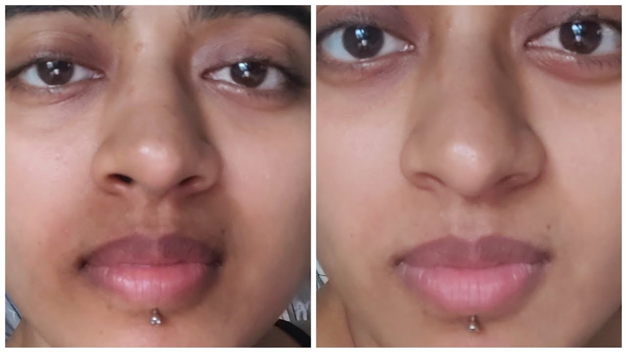 How I Actually Got Rid Of Pigmentation Around My Mouth || Pigmentation Treatment For Mouth Darkness