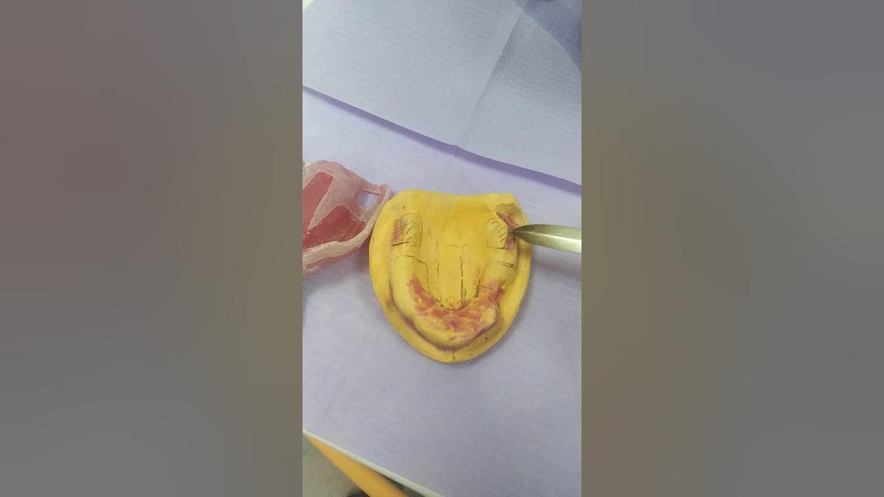 Visit 4 Revising Maxillary Tuberosity types concentrating on the